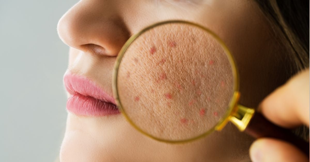 eliminar el acné - Así puede eliminar el acné dependiendo de la zona en donde aparece; no siempre es la misma causa